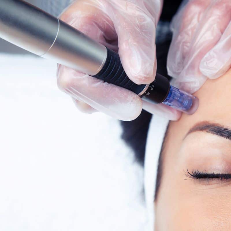 Morpheus8 treatment Uppingham from Lipo Sculpt - Book in today!