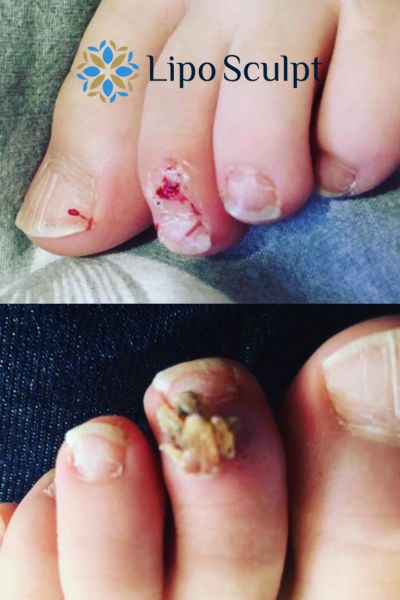 Wart removal customer results from Lipo Sculpt Uppingham